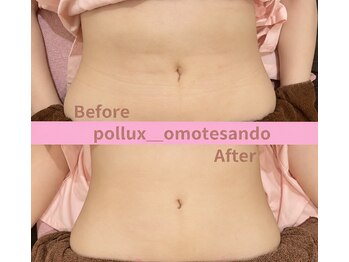 ポルクス鍼灸整骨院 表参道(Pollux鍼灸整骨院)/インディバ　ダウダウンタイム