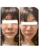 晴(HARE)/フェイシャル【before→after】