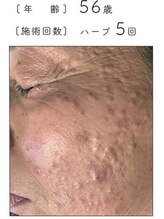 ノーブル 新宿南口(NOBLE)/ハーブピーリング専門新宿