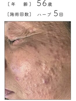 ノーブル 新宿南口(NOBLE)/ハーブピーリング専門新宿