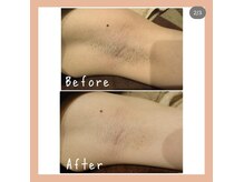 スタジオコノハ(studio508 konoha)/わき脱毛