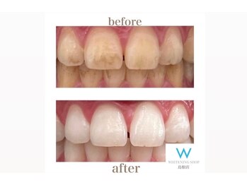 ホワイトニングショップ 島根店/Before&After美白ホワイトニング