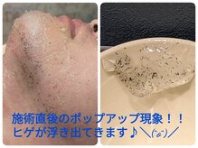 フリーダム(Freedom)/【脱毛施術直後写真】