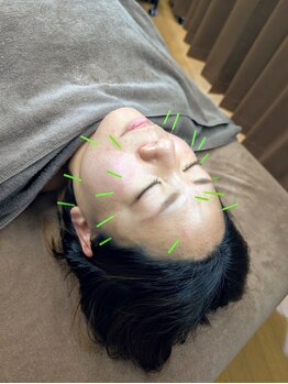 のなか鍼灸院の写真/初めて美容鍼や鍼灸をされる方におすすめ！豊富な知識と経験をを兼ね備えたプロの鍼灸師による施術！