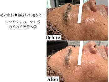 フレイヤ(FREYA)/毛穴専科Before→Afterr