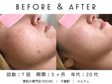ロエヴェ(ROEWE)/ニキビ改善・毛穴ケア・肌質改善