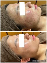 エスプリ 新宿店/毛穴洗浄・毛穴レス・アクネケア