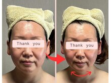 リセル(Recell)/小顔☆脂肪分解