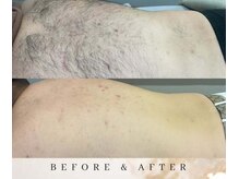 ゼロ アンド リセット(0ZERO&RESET)/【メンズ脱毛】0ZERO&RESET