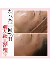 アルムダアクア 天王寺店(Aleumda AQUA)/ハーブピーリング/大阪/天王寺