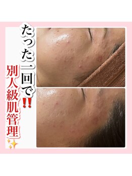 アルムダアクア 天王寺店(Aleumda AQUA)/ハーブピーリング/大阪/天王寺