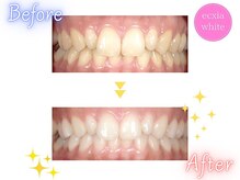 エクシアホワイトニング 八王子店/ホワイトニングビフォーアフター