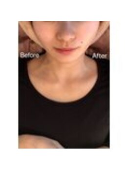 小顔・痩身専門店Lift(リフト)練馬/小顔専門店Lift|Before After