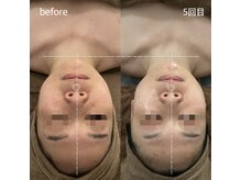 サロンワイアネシス(Salon y ANESIS)/小顔コルギ　5回の変化