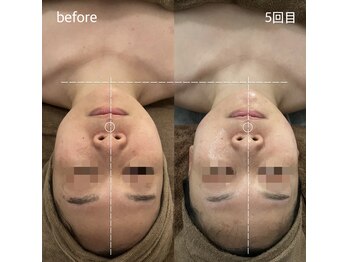 サロンワイアネシス(Salon y ANESIS)/小顔コルギ　5回の変化