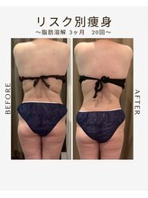 ビーシェイプ 君津(B-Shape)/【痩身】ビフォーアフター