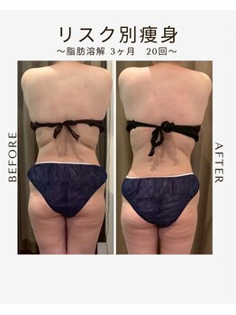 ビーシェイプ 君津(B-Shape)/【痩身】ビフォーアフター