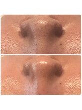 ティアーナ(Tiaana)/毛穴洗浄