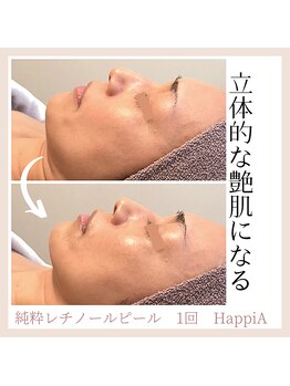 ハピア(HappiA)/純粋レチノールピール　