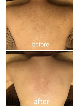 リバース(Rebirth)/背中のニキビ、黒ずみは大敵!!