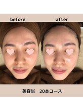 サクラ(Sakura)/美容鍼20本コース　before after