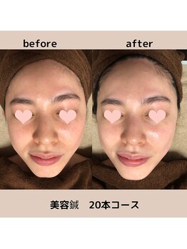 サクラ(Sakura)/美容鍼20本コース　before after