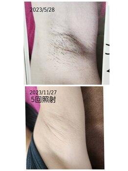 ソレイユ/ワキ脱毛