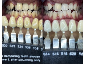 トウキョースワーズ 渋谷店(TOKYO SWRS)/#ホワイトニング #渋谷 #池袋