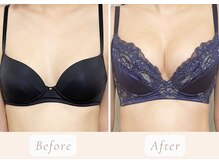 ノルン(Norn)/20代バストアップ