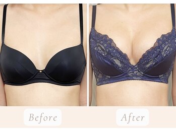 ノルン(Norn)/20代バストアップ