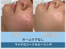 アロマ(AROMA)/凹凸跡/毛穴/越谷せんげん台