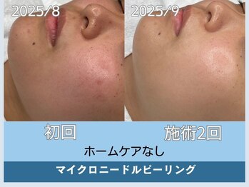 アロマ(AROMA)/凹凸跡/毛穴/越谷せんげん台