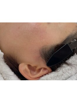 顔脱毛がしたい