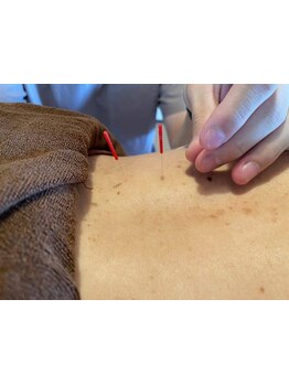 鍼灸施術を受けたい