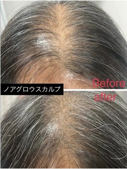 ニューユー(NewYou)/ノアグロウスカルプ