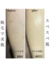 イーストモア(EAST MOIS)/脱毛で美肌ゲット☆