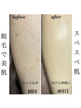 イーストモア(EAST MOIS)/脱毛で美肌ゲット☆