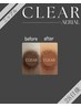 【黒ずみケア】CLEAR  ニップル(乳輪) ご相談０円
