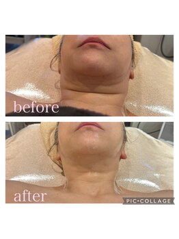 モンスリール 麻布十番(Mon Sourire)/キャビテーションフェイシャル