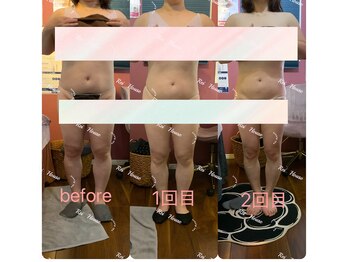 レイ 本厚木(Rei)/脂肪冷却のビフォーアフター