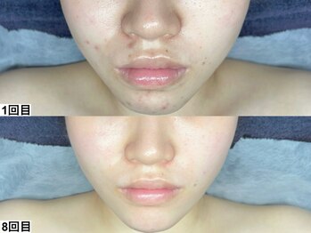 アンドミー 岡山店(&me)/ララピール【艶肌/肌質改善】