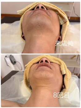 ティアレ 緑井店(Tiare)の写真/メンズ脱毛は当たり前の時代!ヒゲ脱毛で毎朝の面倒な髭剃りから解放!ワキ脱毛で汗のニオイ予防にも♪