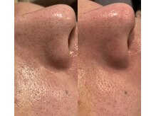 スプレール 水戸店/毛穴洗浄