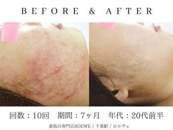 ロエヴェ(ROEWE)/ニキビ改善・毛穴ケア・肌質改善