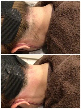 ビープラス(B plus)/うなじWAX脱毛で理想のうなじへ