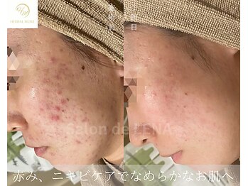 サロンドレナ 名駅店/ハーブピーリング サロンドレナ