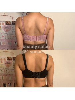 ヴィーナス(Venus)/バストアップで美整骨アプローチ