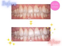 エクシアホワイトニング 八王子店/ホワイトニングビフォーアフター