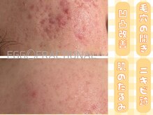 ザ ピーチ(THE PEACH)/エステ版ポテンツァ