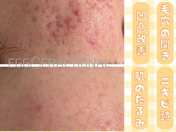 ザ ピーチ(THE PEACH)/エステ版ポテンツァ